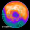 Stress/rest N13 ammonia cardiac PET