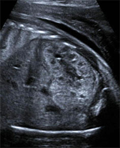 Normal high resolution ultrasound of fetal kidney.