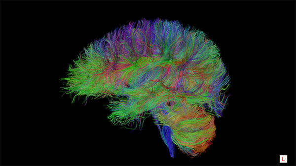 Diffusion tensor imaging (DTI)-based whole-brain tractogram in an adolescent