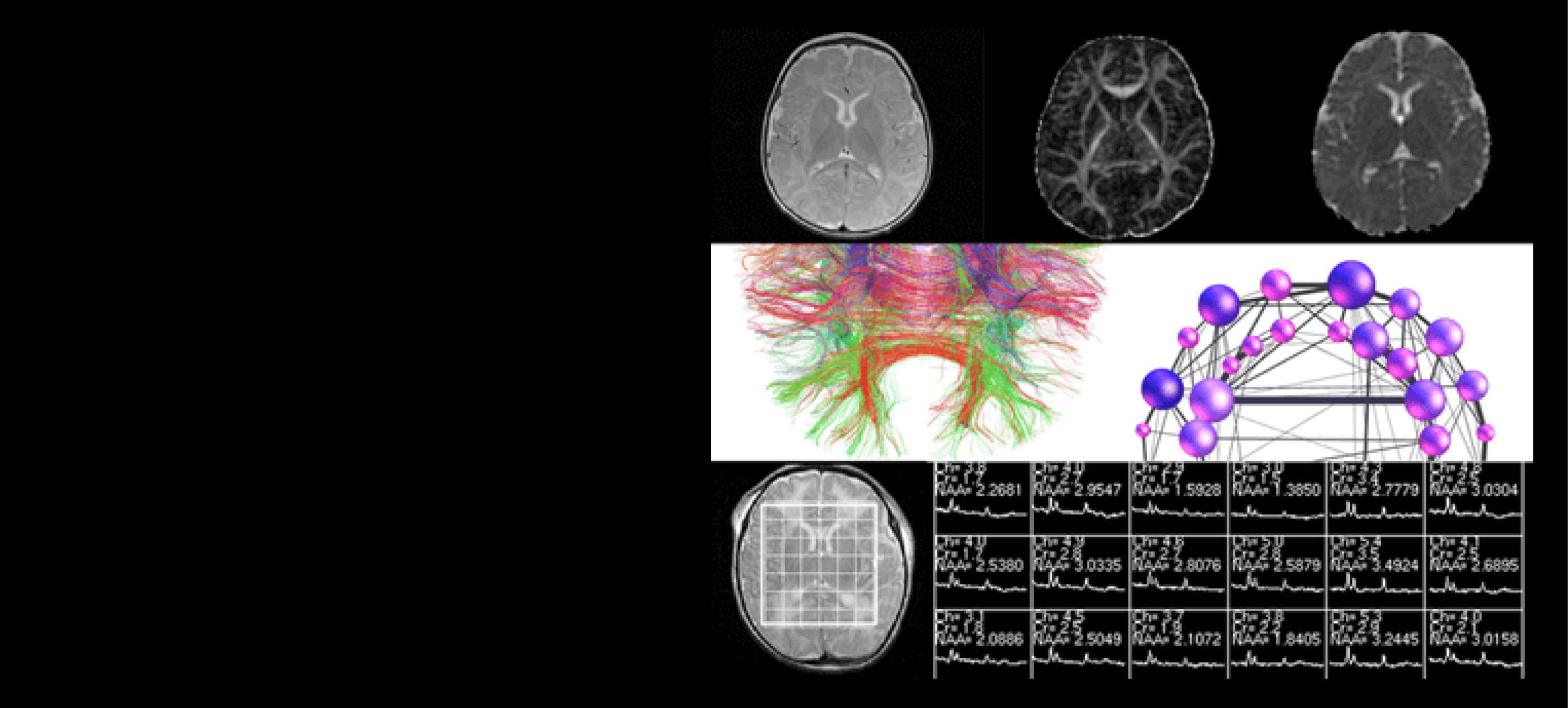 Composite image showing brain MRI scans, fiber tractography, brain connectivity network visualization, and MR spectroscopy data used in neuroimaging and machine learning analysis.