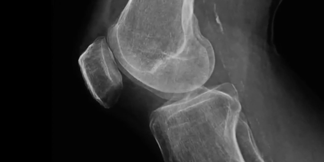 MRI image of the knee highlighting bony anatomy and joint surfaces used for musculoskeletal imaging analysis.