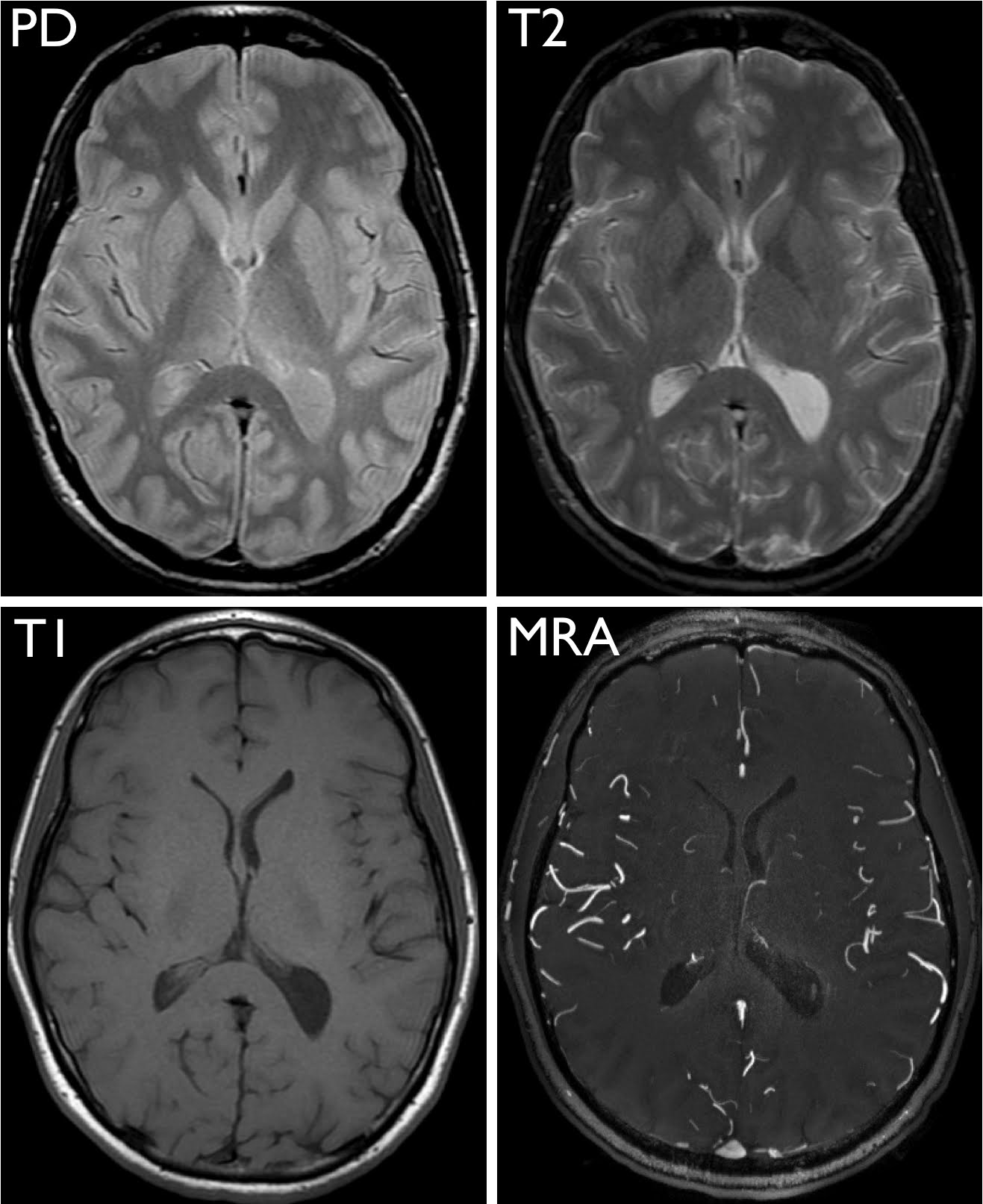 mri images of the brain