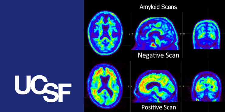 Role in Determining the Impact of Amyloid PET Imaging on Real-World Alzheimer's Disease and Dementia Care | UCSF Radiology