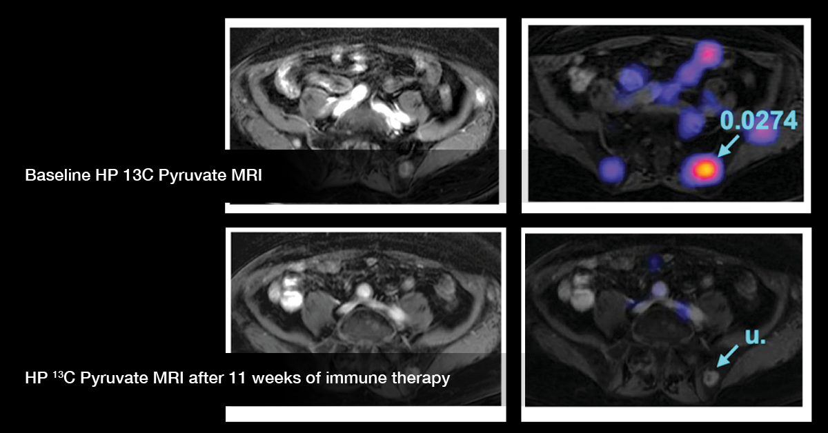 Hyperpolarized MRI Technology Resource Center: New MRI Technology To ...