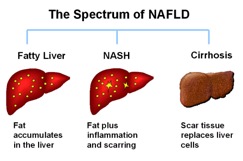 Spectrum of NAFLD