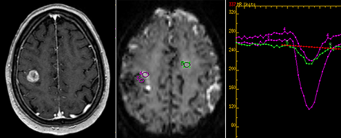 Brain tumor research