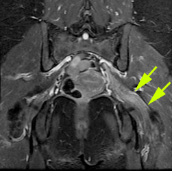 Spinal stenosis | Myelography | UCSF Radiology