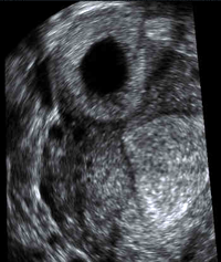 Ectopic Pregnancy Imaging - UCSF Medical