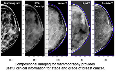 DCIS | Ductal carcinoma in situ (dcis) | UCSF Radiology