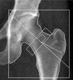 Bone Density Scan (DXA) | UCSF Radiology