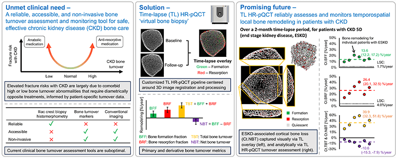 Graphical abstract showing time lapse HR pQCT as a noninvasive virtual bone biopsy for assessing bone turnover in chronic kidney disease, comparing baseline and follow up bone images with measures of bone formation, resorption, and localized bone loss.