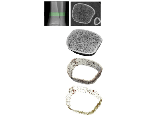 Series of images showing HR pQCT imaging of a peripheral bone, including scan location, cross sectional view, and separated visualizations of trabecular bone, cortical bone, and cortical porosity.