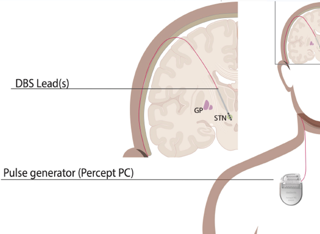 Deep Brain Stimulation: Figure design Dr. Sandoval-Pistorius, Neurology.