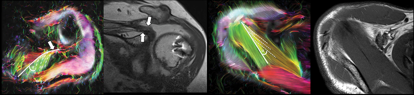 Four-panel shoulder imaging figure comparing colorful diffusion tractography with conventional MRI. Tractography panels depict muscle fiber orientation around the shoulder, with white arrows and angle annotations highlighting selected anatomical regions.