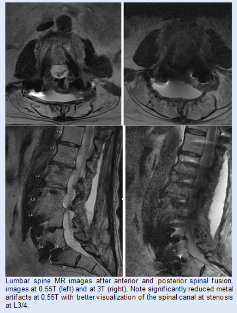 Comparison of lumbar spine MRI images after anterior and posterior spinal fusion acquired at 0.55T and 3T, showing reduced metal artifact at lower field strength and improved visualization of the spinal canal at the L3 L4 level.