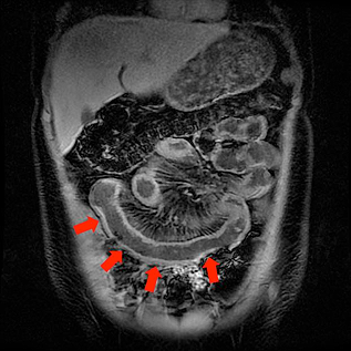 Patient with Crohn’s disease showing multiple=