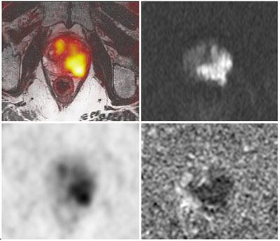 PSMA_PET-MRI.jpg