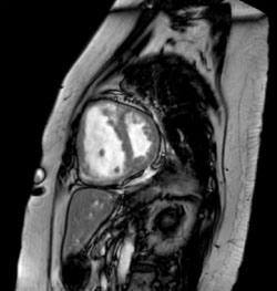 SagittalSteady tateFreePrecessionCMR.jpg