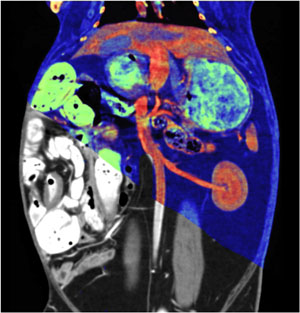 Dual-energy CT (DECT) image