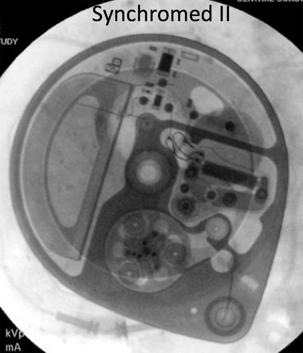 Synchromed_II.png