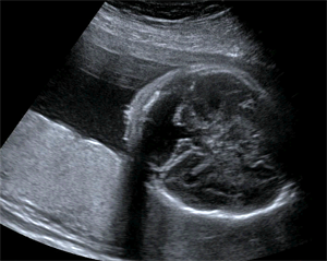 Dandy Walker Malformation