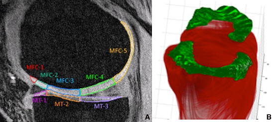 Knee MRI showing labeled regions of the meniscus and tibial cartilage, alongside a 3D model highlighting joint surfaces used to analyze cartilage contact and load distribution.