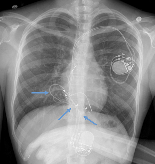 Pacemaker with epicardial leads