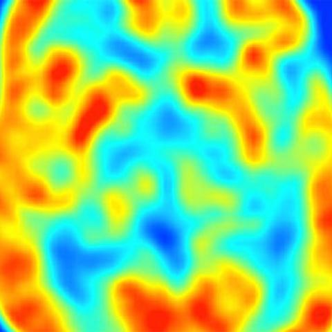 2000:  UCSF research scientists led by Bruce Hasegawa, PhD, combine SPECT functional imaging with CT anatomical imaging to produce the first dual-modality imaging system, SPECT/CT.