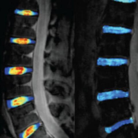 2011: Studies began at UCSF on the use of T1ρ quantitative MR imaging, allowing the detection of cartilage injuries not visible with conventional MRI before tissue loss begins. Today, the technique is broadly used to create more treatment options and hasten recovery.