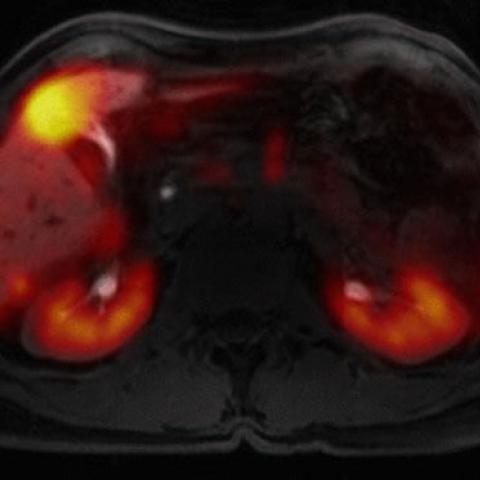 2015: For the first time in the US, full-body, simultaneous time-of-flight PET/MRI became available at UCSF. This state-of-the-art dual imaging technology reduces radiation, enhances image quality, and is safer and more convenient for patients.