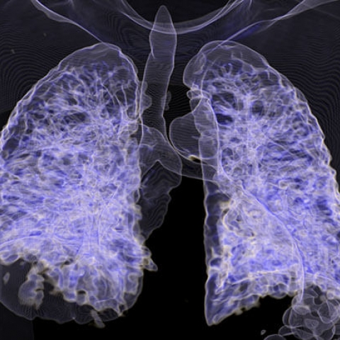 3-D CT COVID-19 in the lungs.