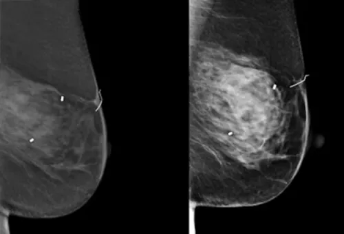 Two side-by-side grayscale mammogram images of a breast displayed against a black background. The images show the breast from two different imaging angles, with small radiopaque markers indicating areas of interest for diagnostic evaluation.