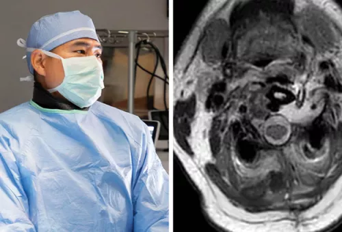 Side-by-side image of a masked neurosurgeon in the operating room and an axial MRI scan of the upper neck before surgery.