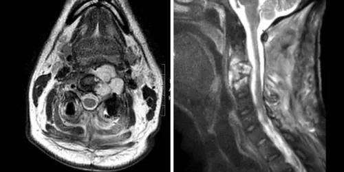 Side-by-side image of a masked neurosurgeon in the operating room and an axial MRI scan of the upper neck before surgery.