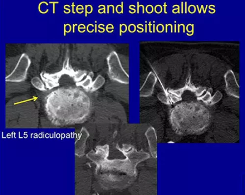 arthrogram-ct