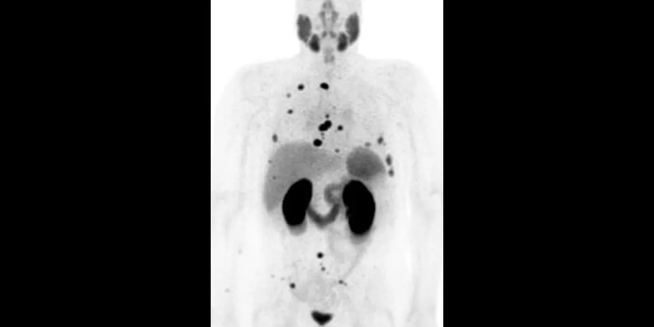 PSMA-PET-image.jpg