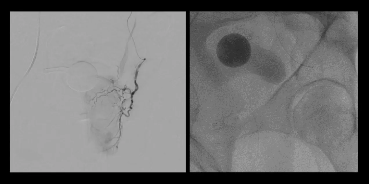 side-by-side fluoroscopic images showing pelvic vascular anatomy; the left panel displays a contrast-filled arterial tree with catheter in place, and the right panel shows a round radiopaque marker and surrounding bony structures during prostate artery embolization