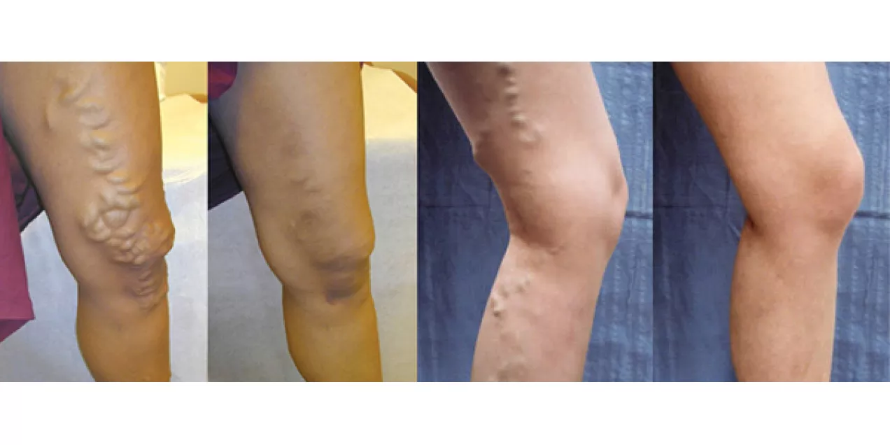 varicose veins on legs shown before and after treatment, with bulging veins reduced in the comparison photos