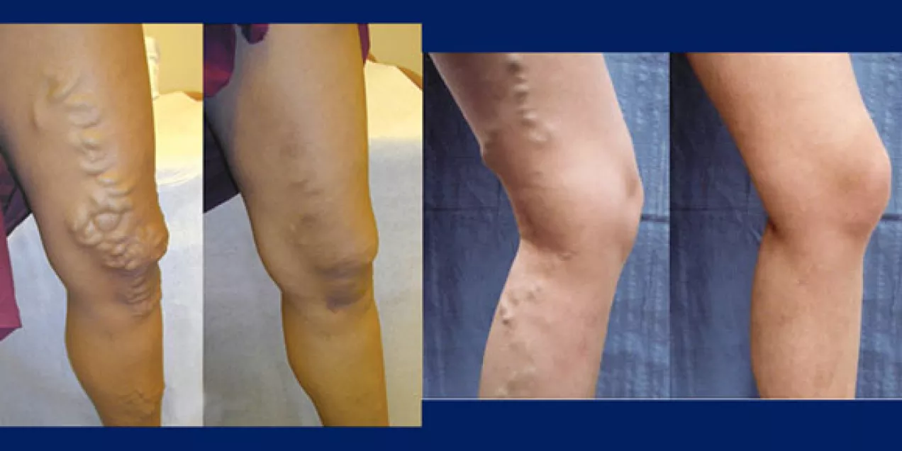 Before and after varicose veins treatment at UCSF Radiology.