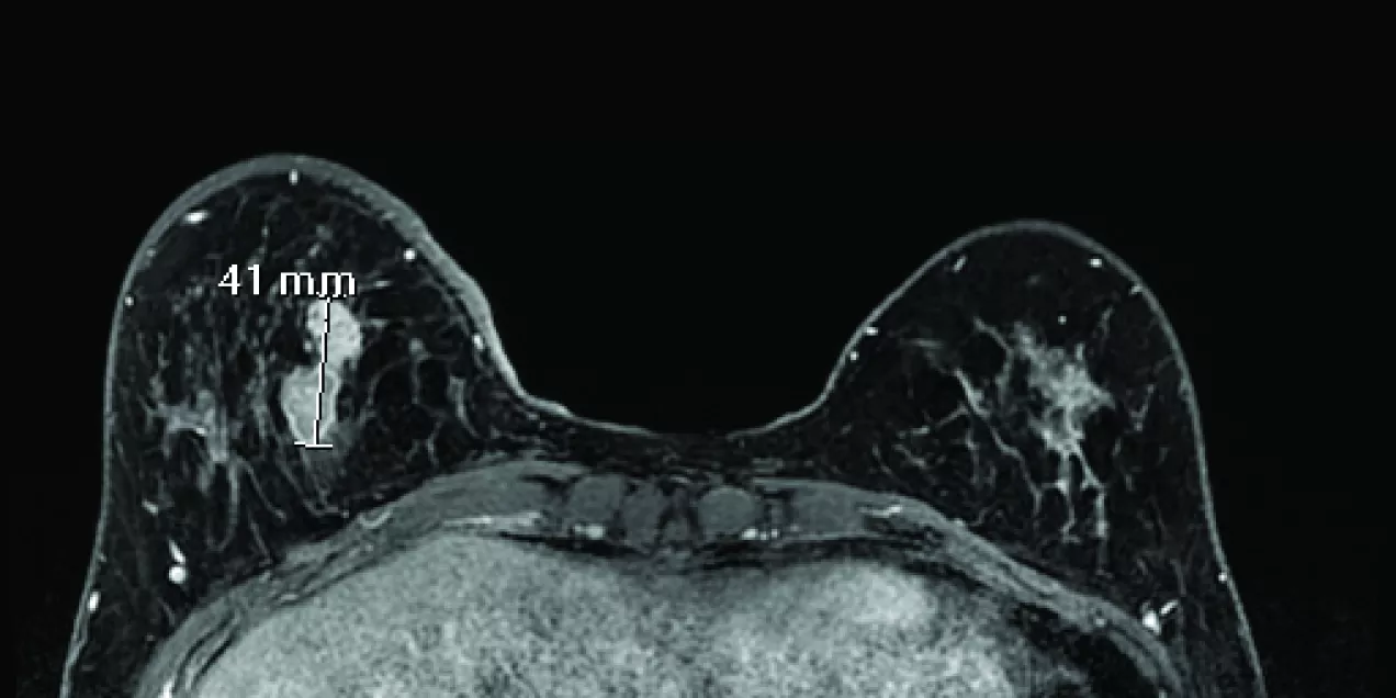 breast MRI scan showing both breasts in axial view with a bright enhancing lesion on the left side marked with a 41 mm measurement indicator, surrounded by fibroglandular tissue against a dark background