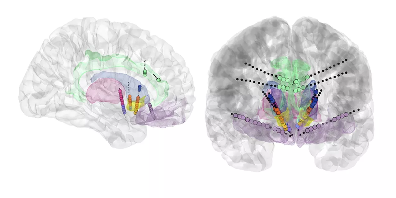 Transparent 3D brain renderings in sagittal and coronal views showing implanted electrode trajectories targeting multiple subcortical regions. Color coded targets include BNST, caudate, thalamus, nucleus accumbens, ventral capsule, cingulate, and orbitofrontal cortex.