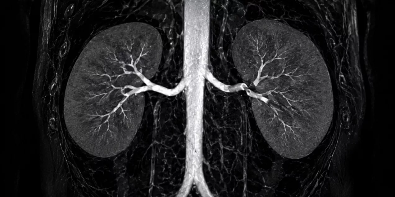 MR angiography image of the kidneys and renal arteries showing narrowing of a renal artery consistent with stenosis.