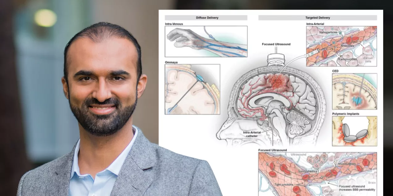 Composite image featuring physician Kazim Narsinh, MD, alongside a medical illustration of focused ultrasound technology. Dr. Narsinh is shown in a professional outdoor portrait wearing a light gray blazer and blue collared shirt. The accompanying diagram depicts targeted drug delivery methods in the brain, including focused ultrasound, blood-brain barrier opening, and therapeutic delivery pathways, highlighting advances in image-guided neurological treatment.