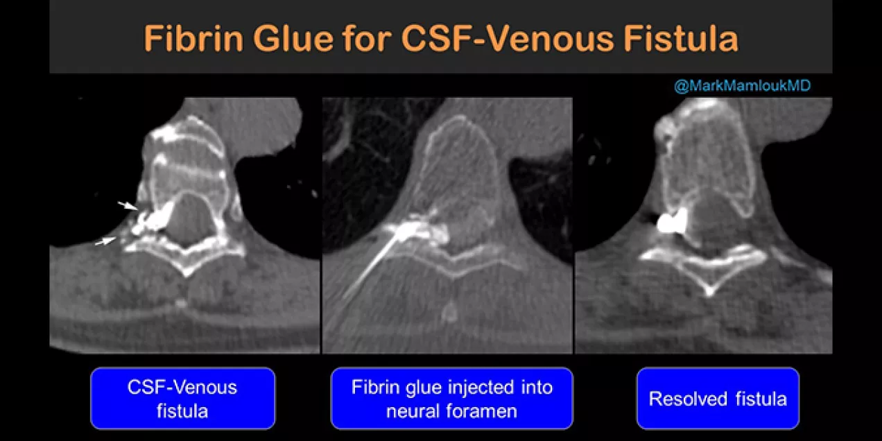 Three side-by-side CT images illustrate treatment of a cerebrospinal fluid (CSF) venous fistula using fibrin glue. The first image shows the fistula, the second shows fibrin glue injected into the neural foramen, and the third shows the resolved fistula after treatment.