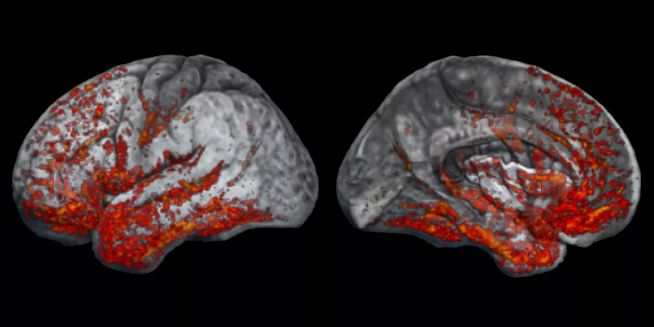 Two side-by-side 3D renderings of the human brain shown against a black background. The brain surfaces are displayed in grayscale, with numerous red and orange highlighted regions overlaid across the cortex. The highlighted areas are concentrated along the lower temporal and occipital regions and extend into portions of the frontal and parietal lobes. The left image shows a lateral (outer side) view of the brain, while the right image shows a medial (inner side) view. The colored overlays appear to represen