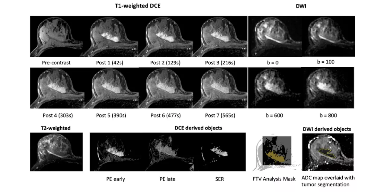 Alt text: Figure showing breast MRI scans and analysis maps used to evaluate a breast tumor and predict treatment response.