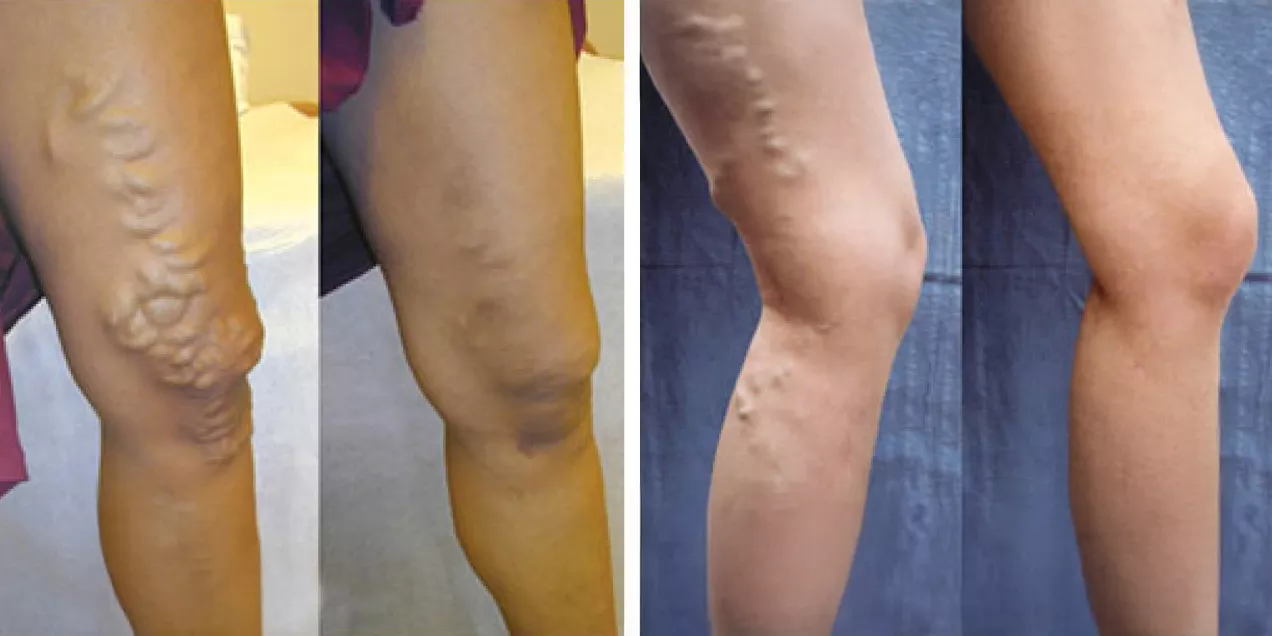 Side-by-side before-and-after clinical photographs of legs with varicose veins. The left images show prominent, bulging veins around the knee and lower thigh before treatment, while the right images show the same areas after treatment with significantly reduced visible veins and a smoother appearance.