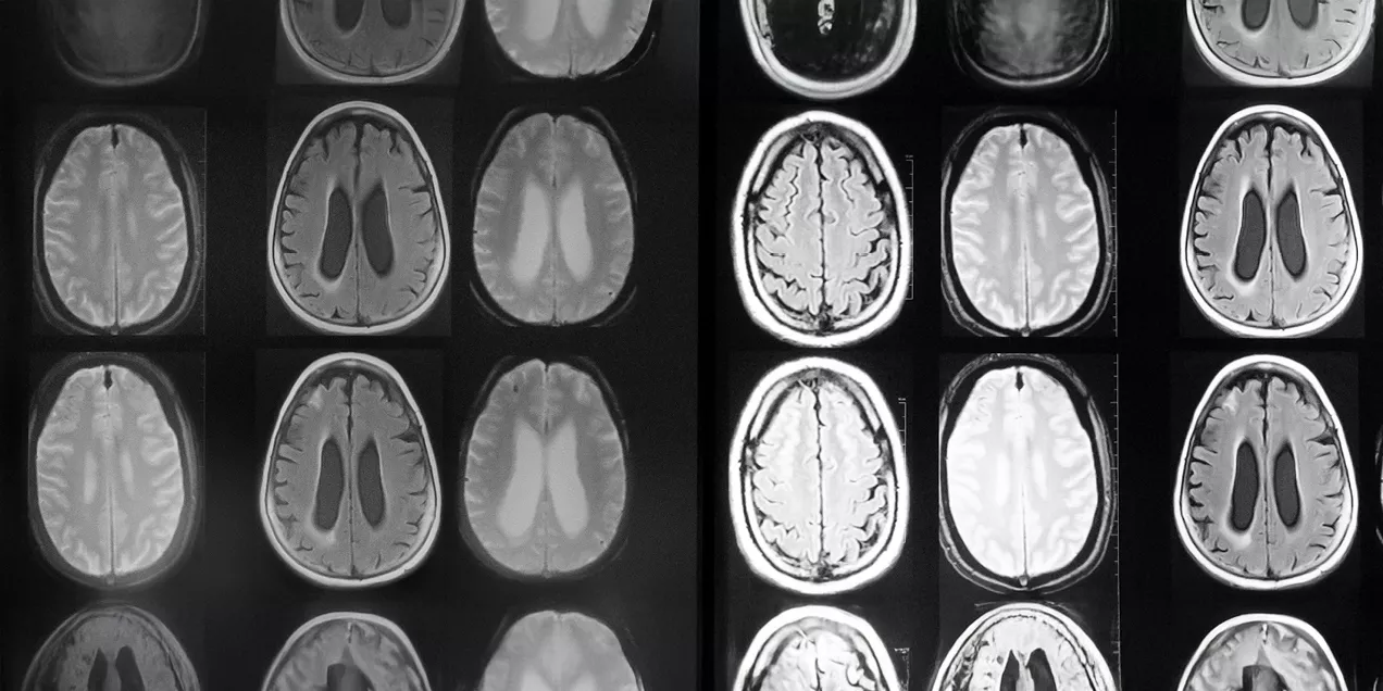 Grid of brain MRI scans displayed side by side, showing multiple cross-sectional views of the brain. The images compare different MRI sequences and illustrate structural changes in brain tissue and ventricular size, highlighting the use of medical imaging to evaluate neurological conditions and disease progression.