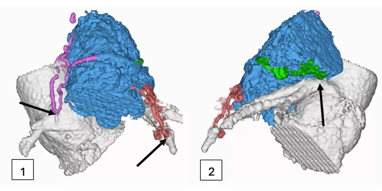 Two 3D cardiac imaging reconstructions compare anatomical variations of the heart and surrounding blood vessels. Color-coded structures highlight the heart chamber in blue and nearby vessels in green, pink, and red. Arrows indicate key anatomical features, illustrating how heart anatomy can differ between individuals.
