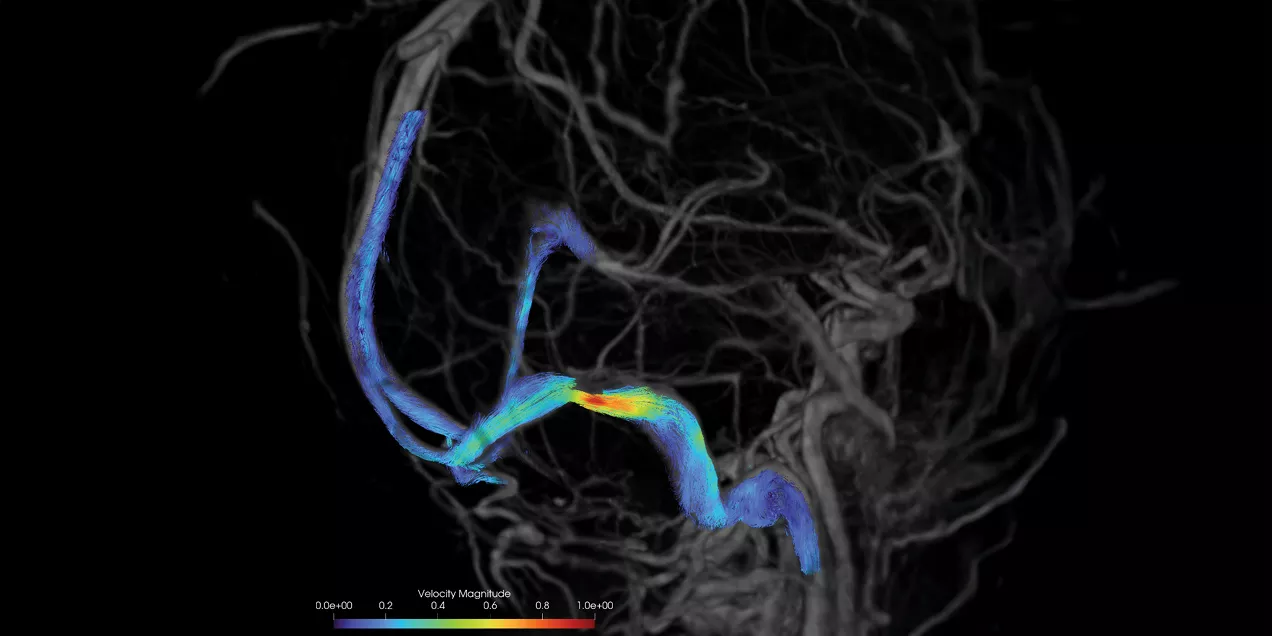 Three-dimensional 4D Flow MRI visualization of blood flow through a narrowed cerebral venous sinus. Color-coded streamlines represent blood flow velocity, with cooler blue tones indicating slower flow and warmer green, yellow, and red tones indicating higher velocities across the stenotic segment. A velocity scale is shown along the bottom of the image.